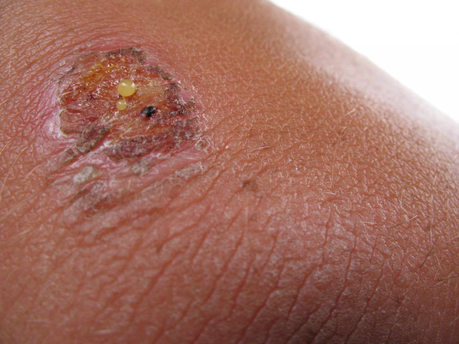 Essential Signs of an Infected Wound
